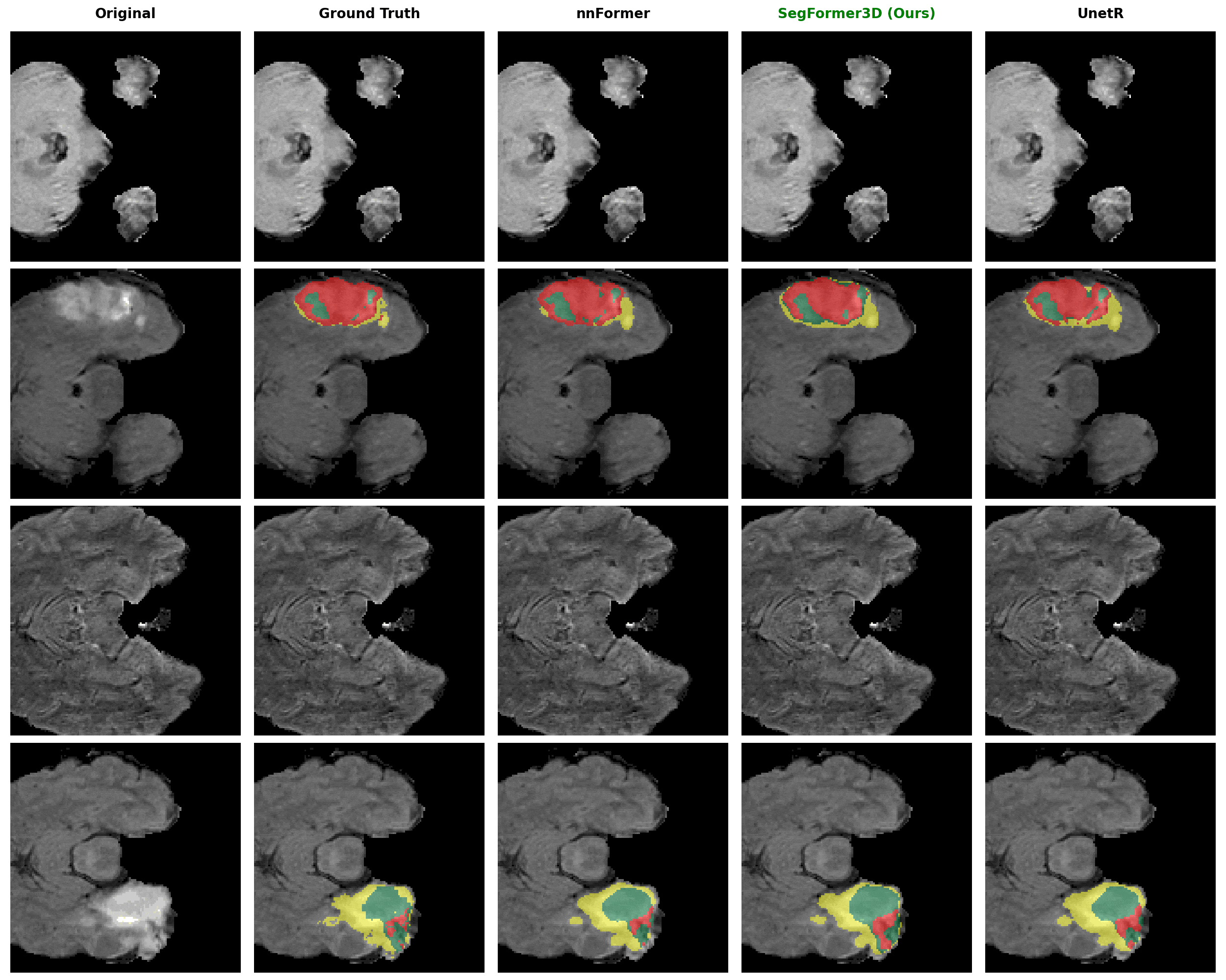 BRaTS Segmentation Results